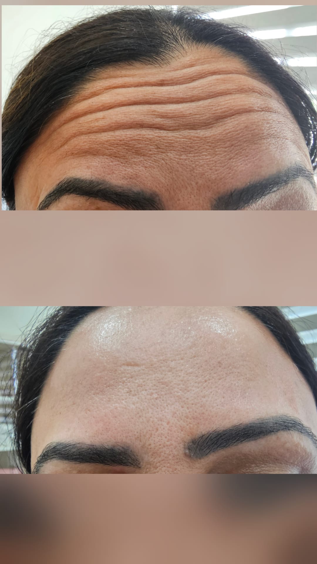 Botox Before & After