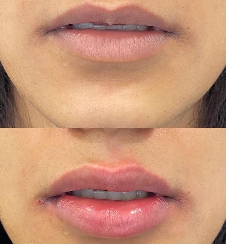 Laser Hair Removal Before & After