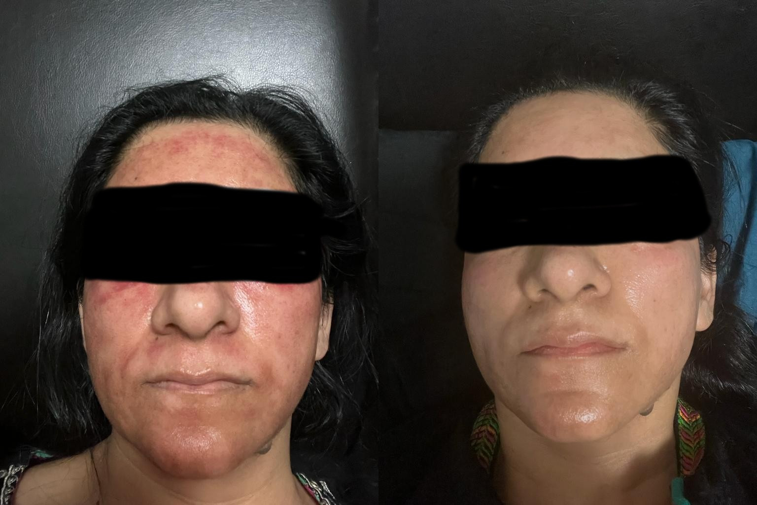 Dermal Filler Before & After