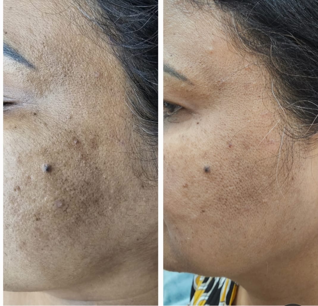 Mesotherapy