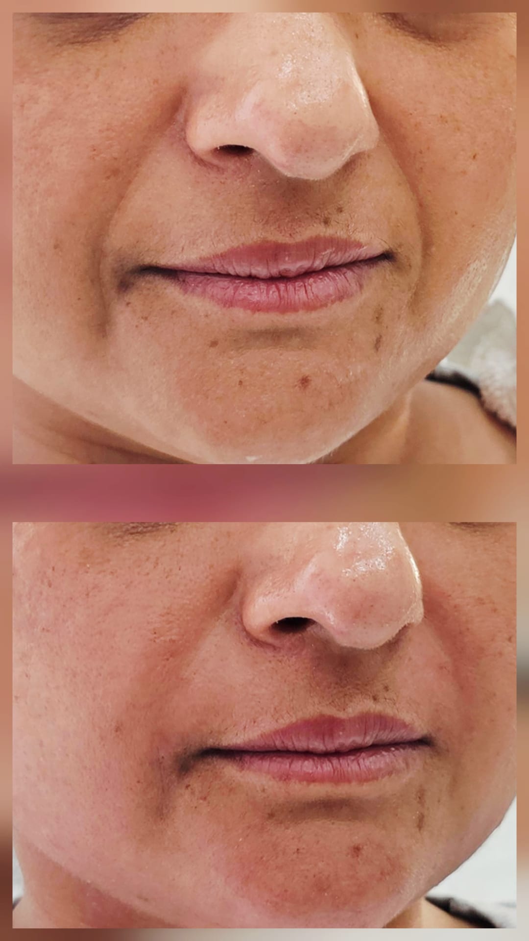 Nasolabial Fillers
