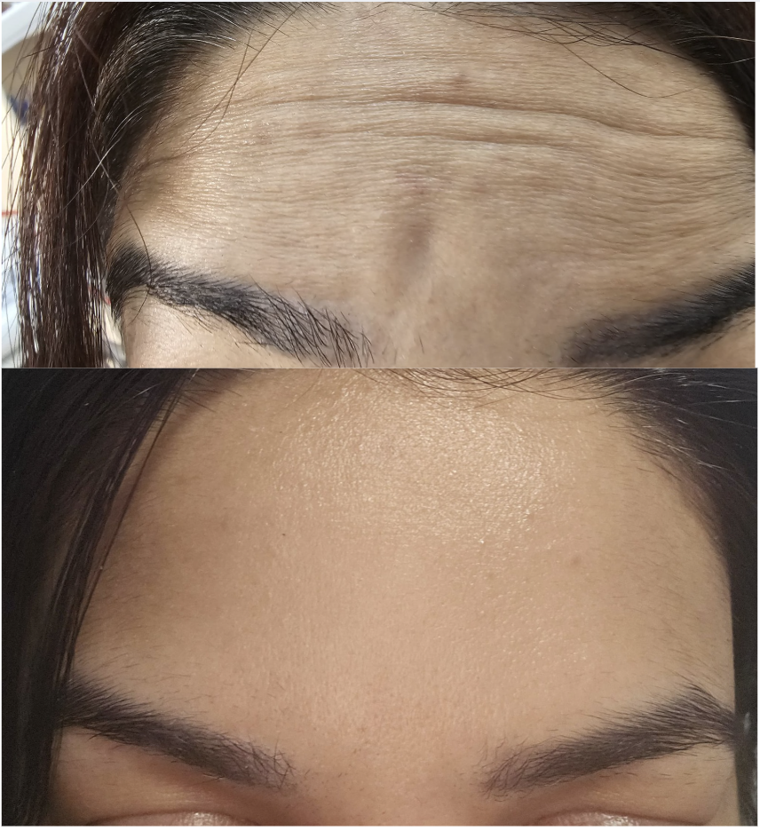 Neutrotoxin Botox treatment